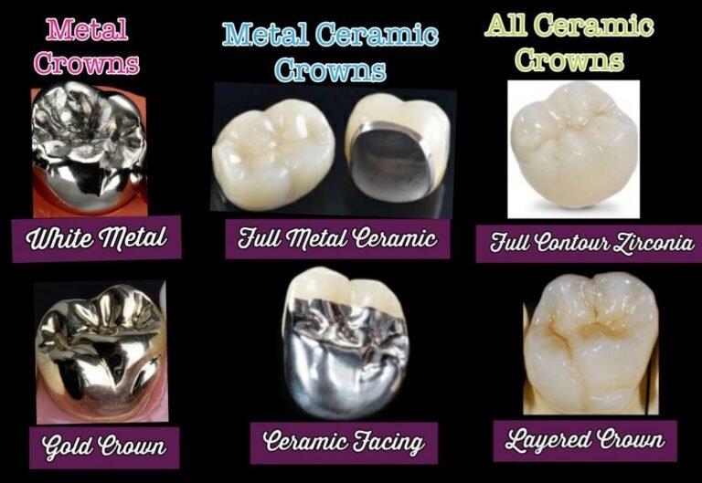 Cost of Crown in Lucknow | Zirconia Crown Cost in Lucknow